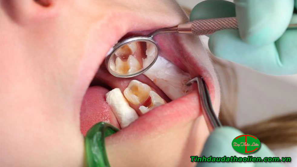 Điều trị S&acirc;u răng ở trẻ em