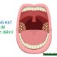 Viêm họng hạt