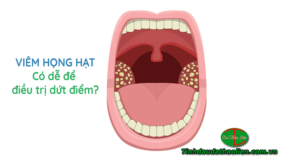 Vi&ecirc;m họng hạt