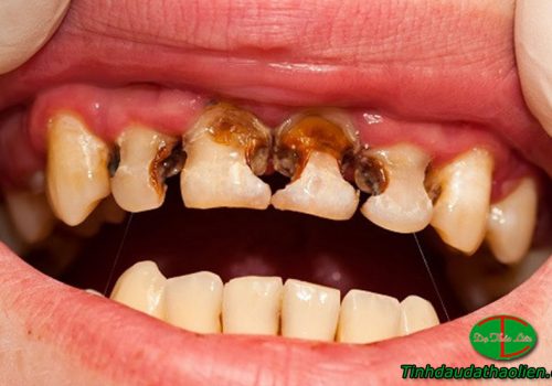 Trẻ bị sâu răng