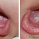 Bệnh nấm miệng