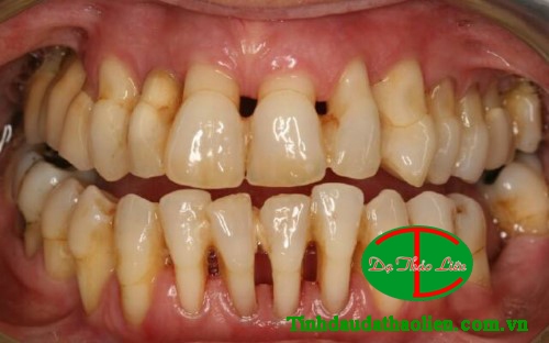 Bệnh viêm nha chu nặng làm răng bị lung lay