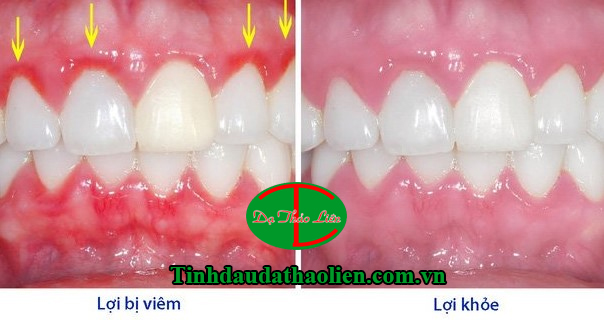 Trị vi&ecirc;m lợi