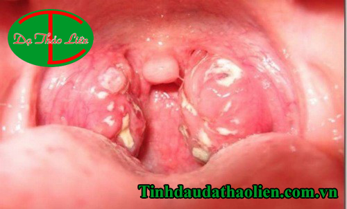 Vi&ecirc;m Họng Hạt