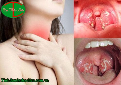 Viêm họng hạt