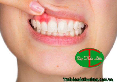 Viêm lợi có mủ