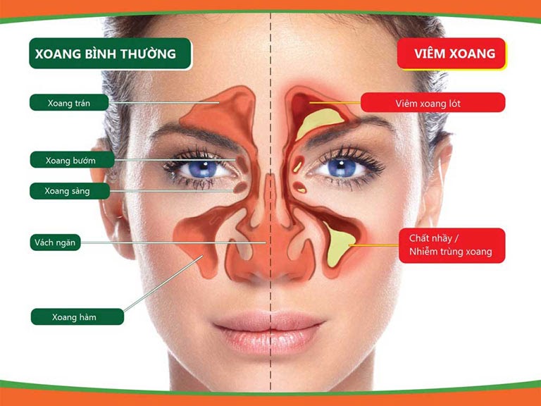 Viêm xoang