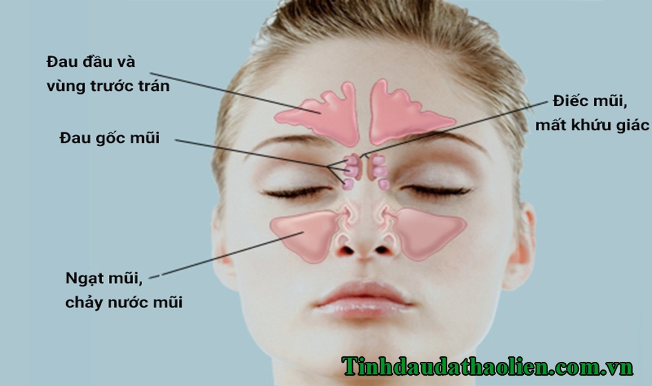 Viêm xoang có tự khỏi được không