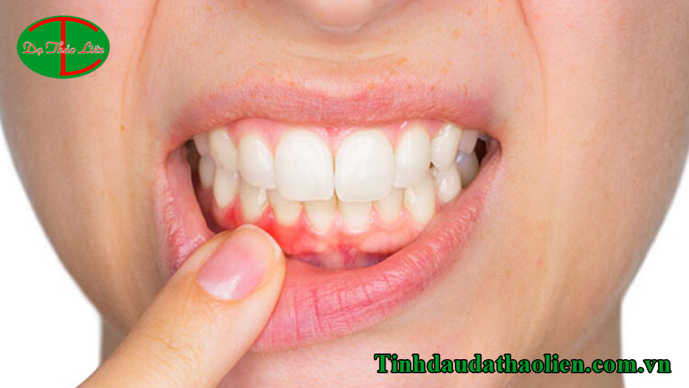Bệnh viêm lợi