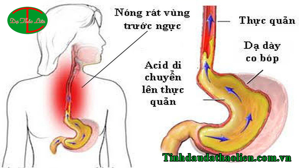 Viêm họng do trào ngược dạ dày thực quản