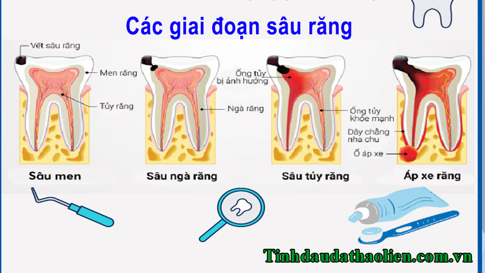 Sâu răng đau nhức phải làm sao