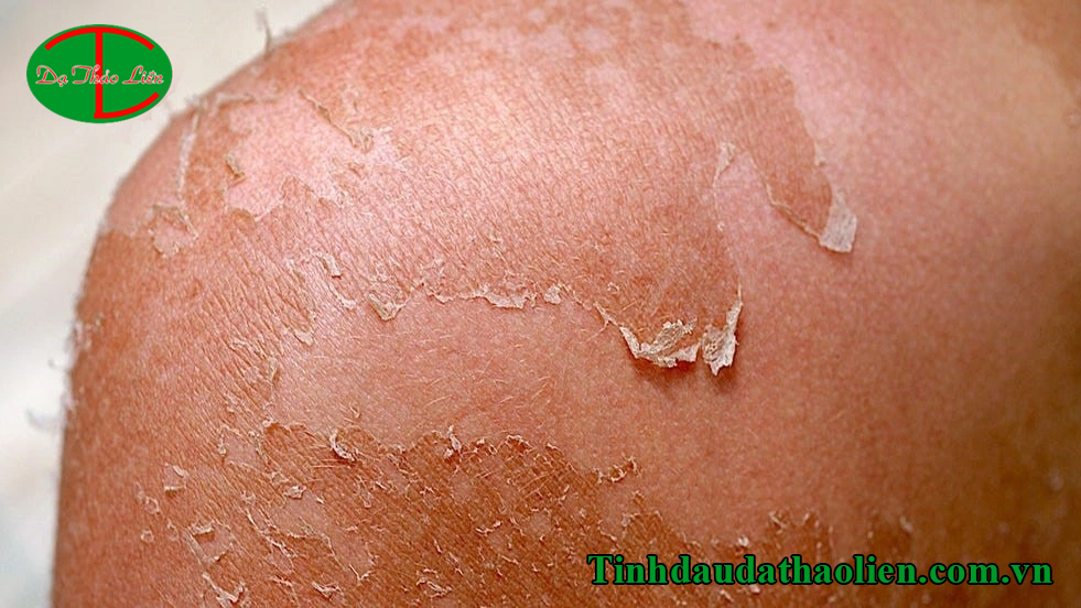 T&aacute;c hại của &aacute;nh nắng mặt trời đối với l&agrave;n da