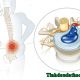 Thoát vị đĩa đệm cột sống thắt lưng